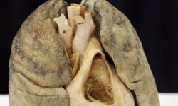 Эмфизема лёгких