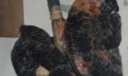 Рак легких (рак легкого)